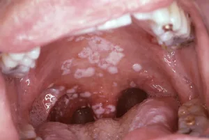 White patches of oral thrush (oral candidiasis) on the roof of an adult's mouth