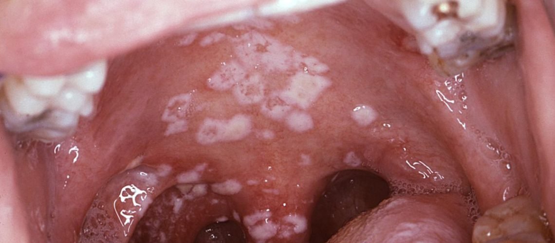 White patches of oral thrush (oral candidiasis) on the roof of an adult's mouth