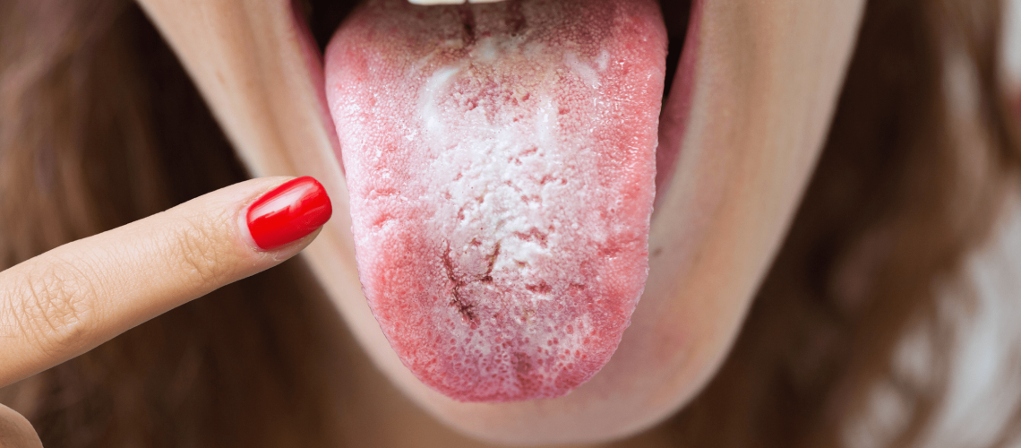 oral_thrush